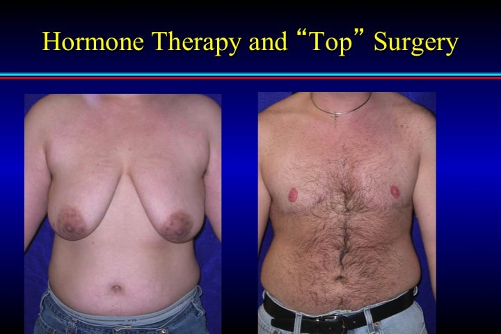 Post Op Clits - Female to Male Surgery Cleveland OH