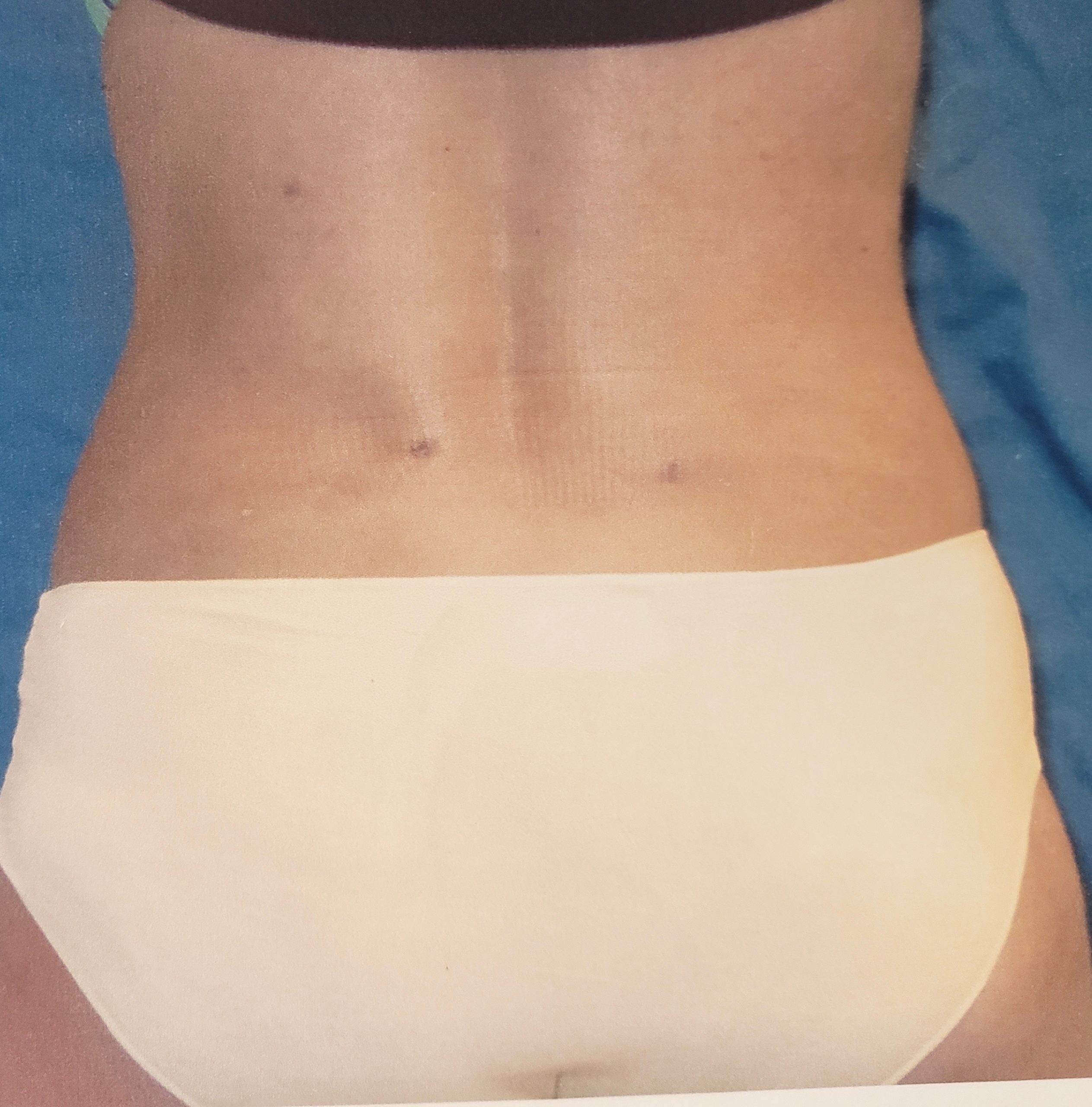 Liposuction Abdomen Treatment Before & After Gallery in New Bern, NC